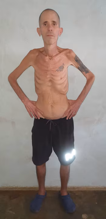 Светлокожий, лысый, очень худой мужчина, стоящий перед светлой стеной, руки на бедрах, в черных шортах и ​​синих сандалиях.