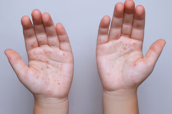 Министерство здравоохранения сообщает, что одиннадцать подтвержденных случаев кори в Сальвадоре соответствуют завозным случаям, а не местной передаче. (Изображение: любезно предоставлено)